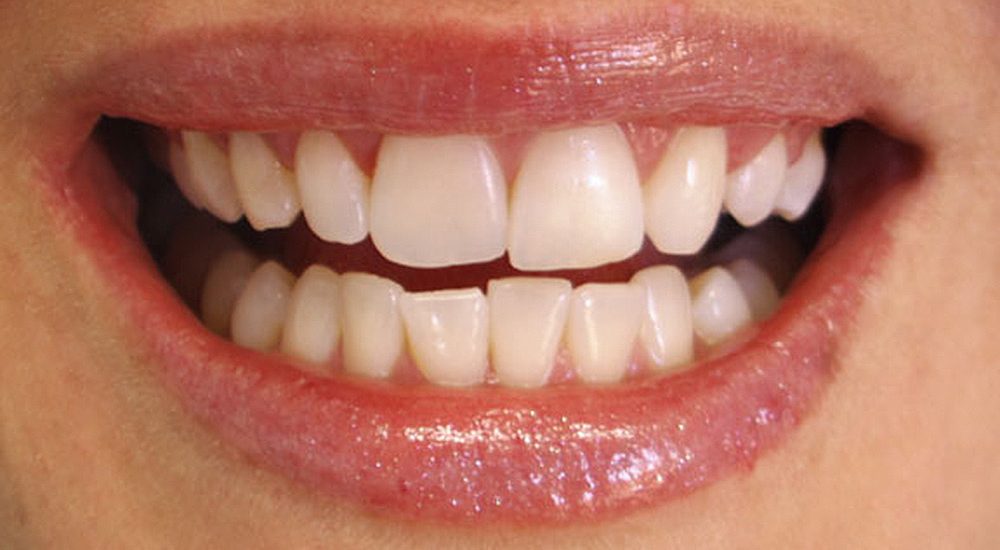 É normal os dentes entortarem após o tratamento ortodôntico?